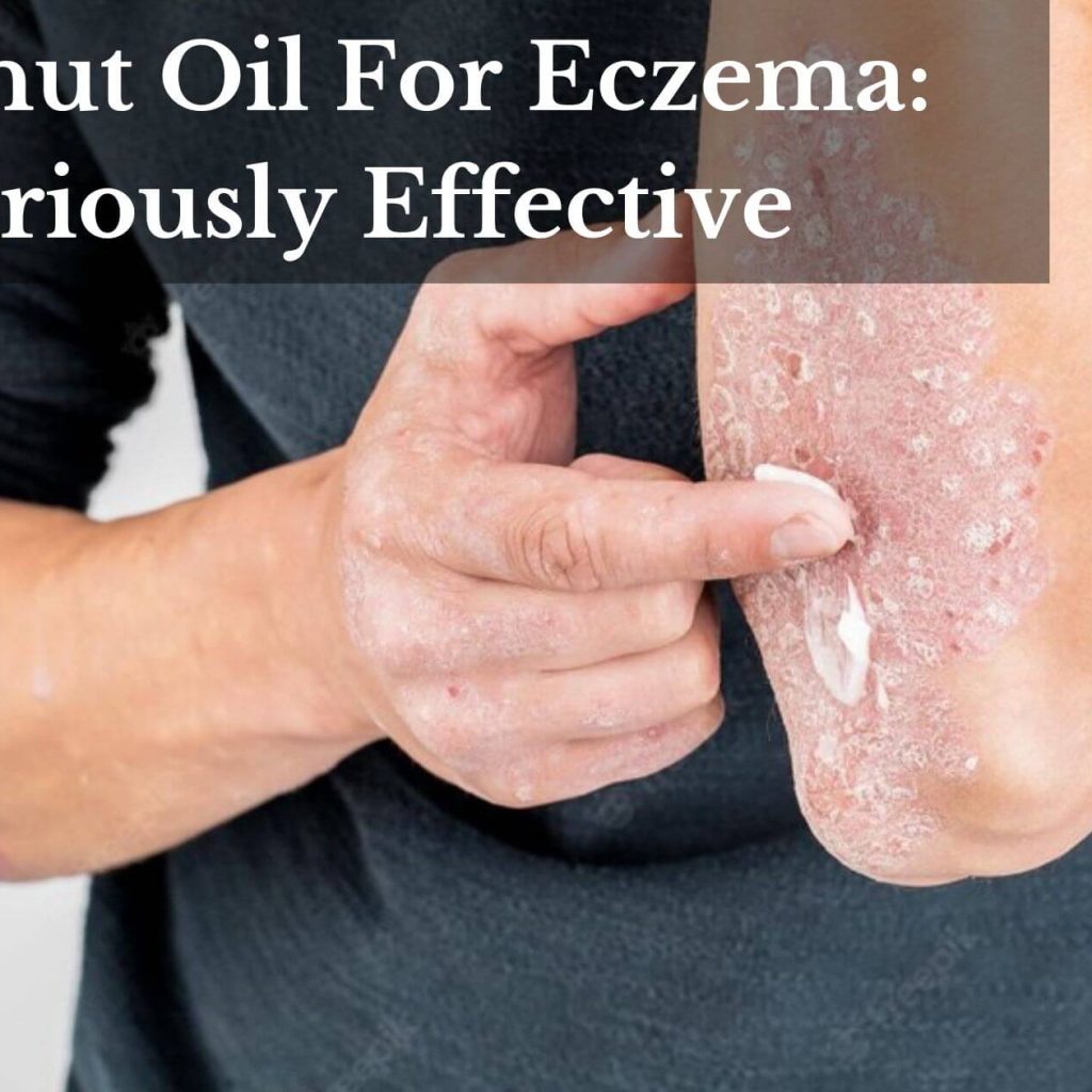 Coconut Oil For Eczema: Curiously Effective