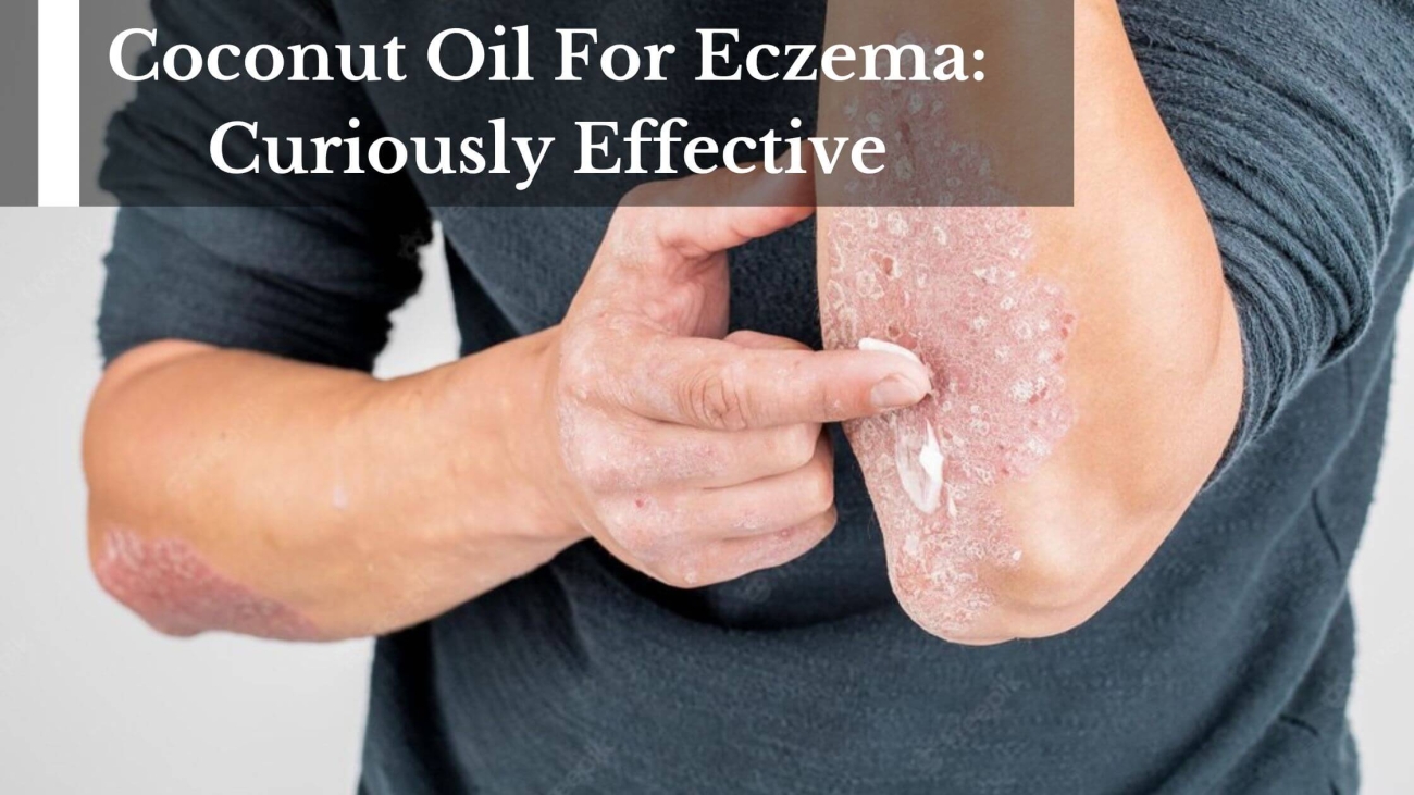 Coconut-Oil-For-Eczema-Curiously-Effective-1