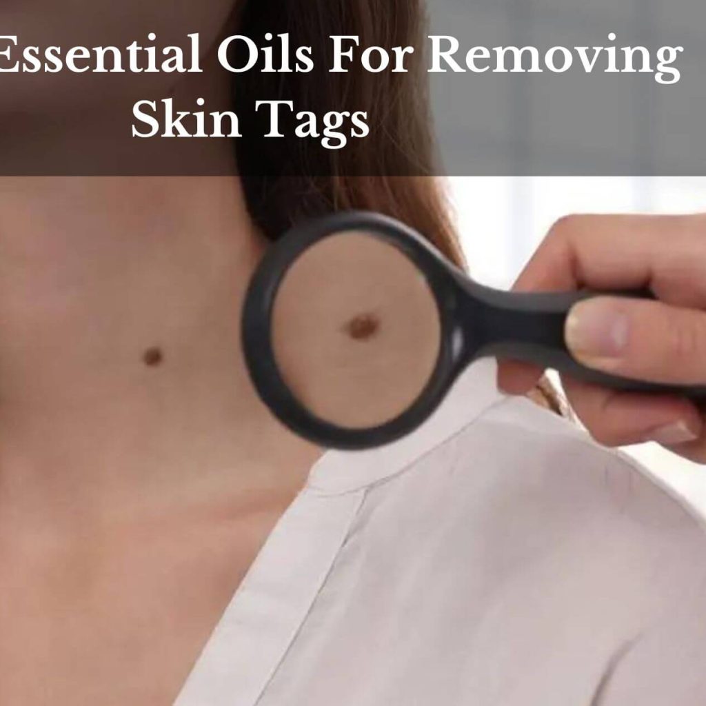 Top 5 Essential Oils For Removing Skin Tags 