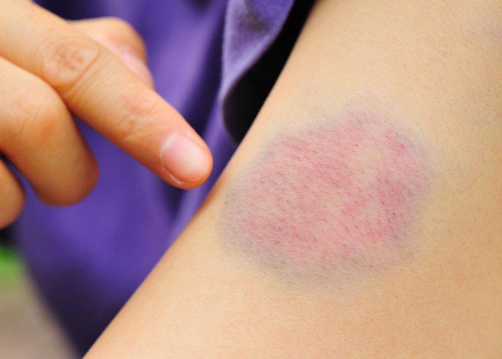 Can You Use Arnica Oil Alone For Bruises?