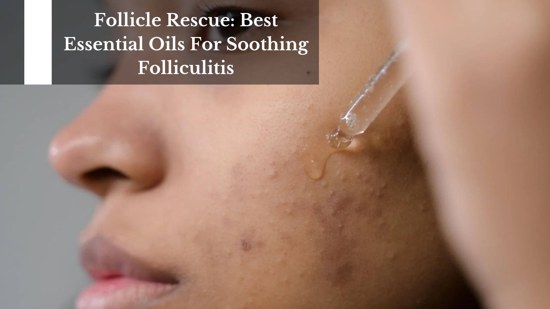 Follicle Rescue Best Essential Oils For Soothing Folliculitis