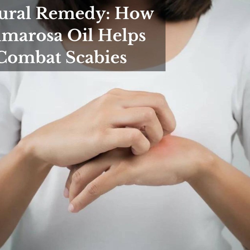 Natural Remedy: How Palmarosa Oil Helps Combat Scabies