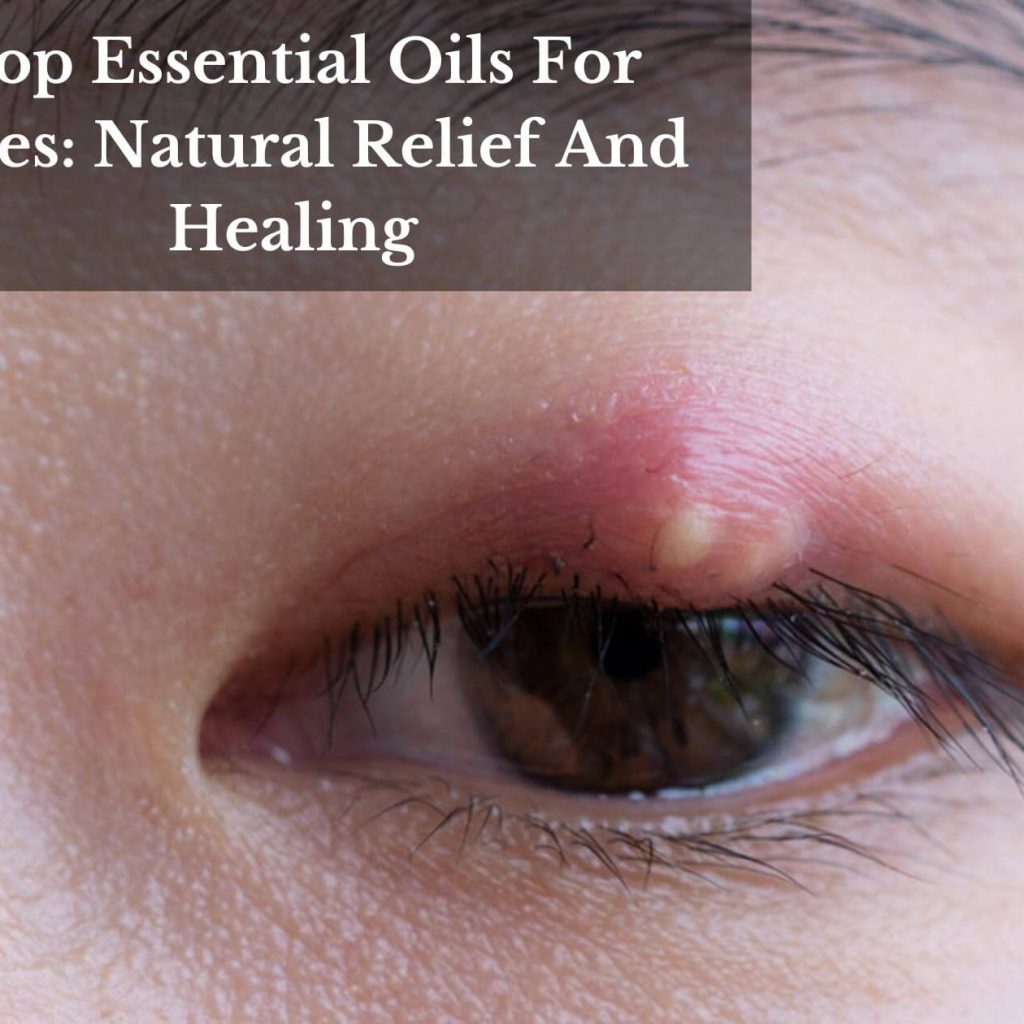 Top Essential Oils For Styes: Natural Relief And Healing