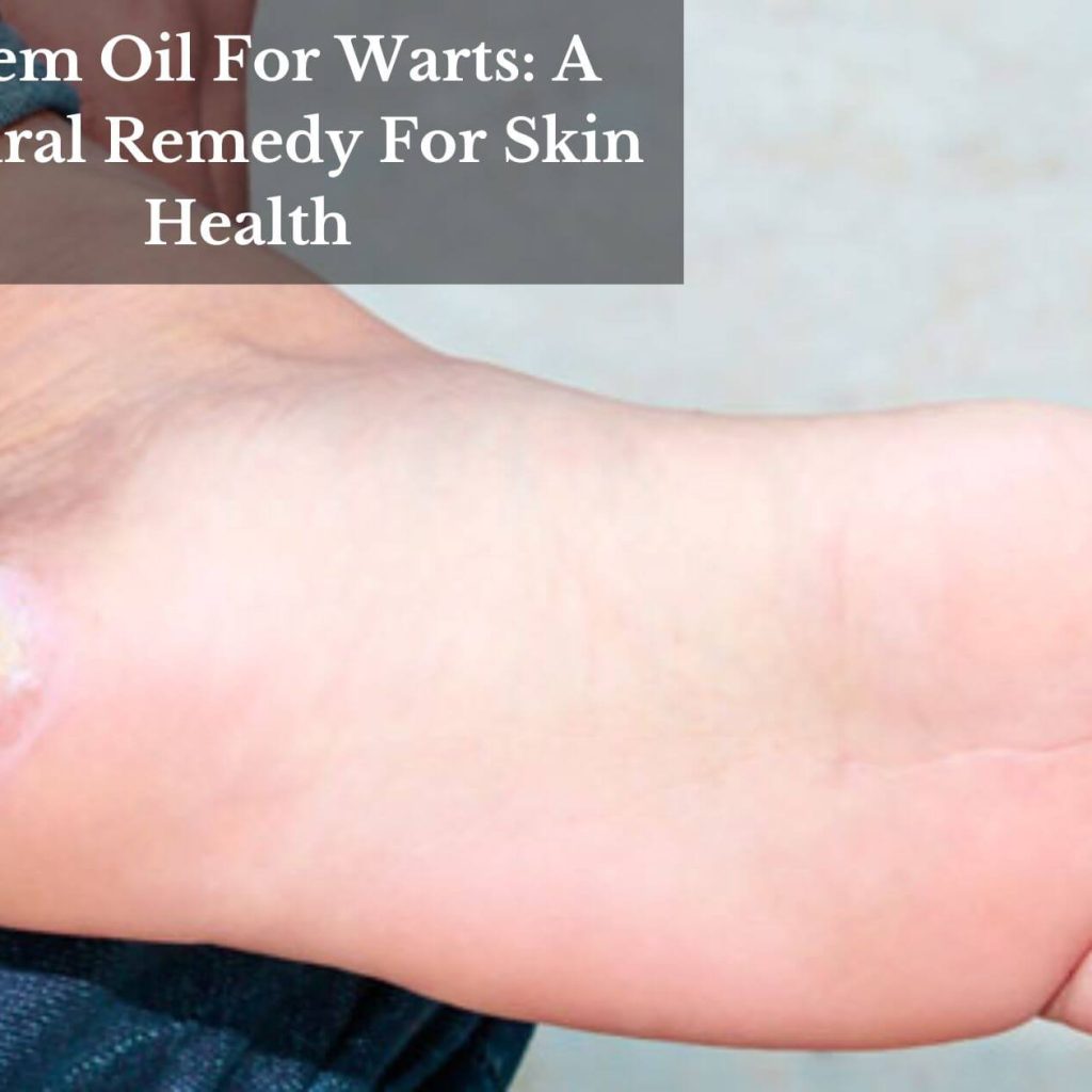 Neem Oil For Warts: A Natural Remedy For Skin Health