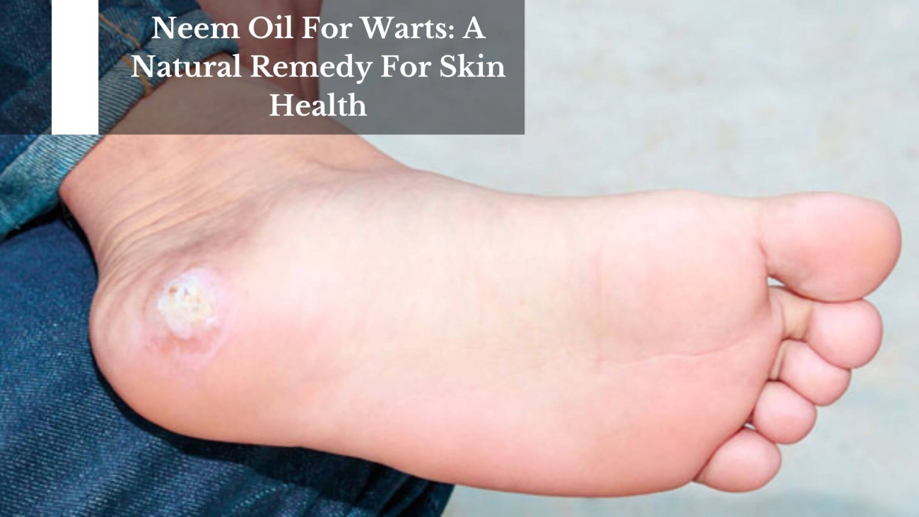 Neem Oil For Warts A Natural Remedy For Skin Health (1)