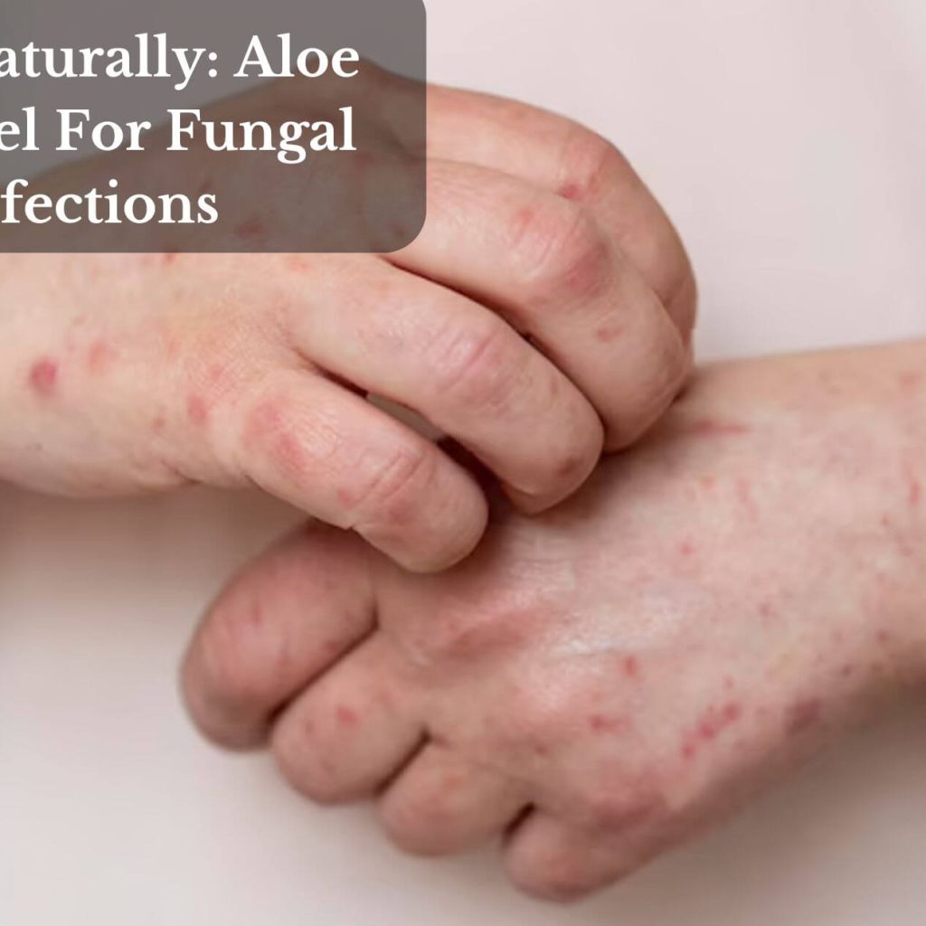 Heal Naturally: Aloe Vera Gel For Fungal Infections